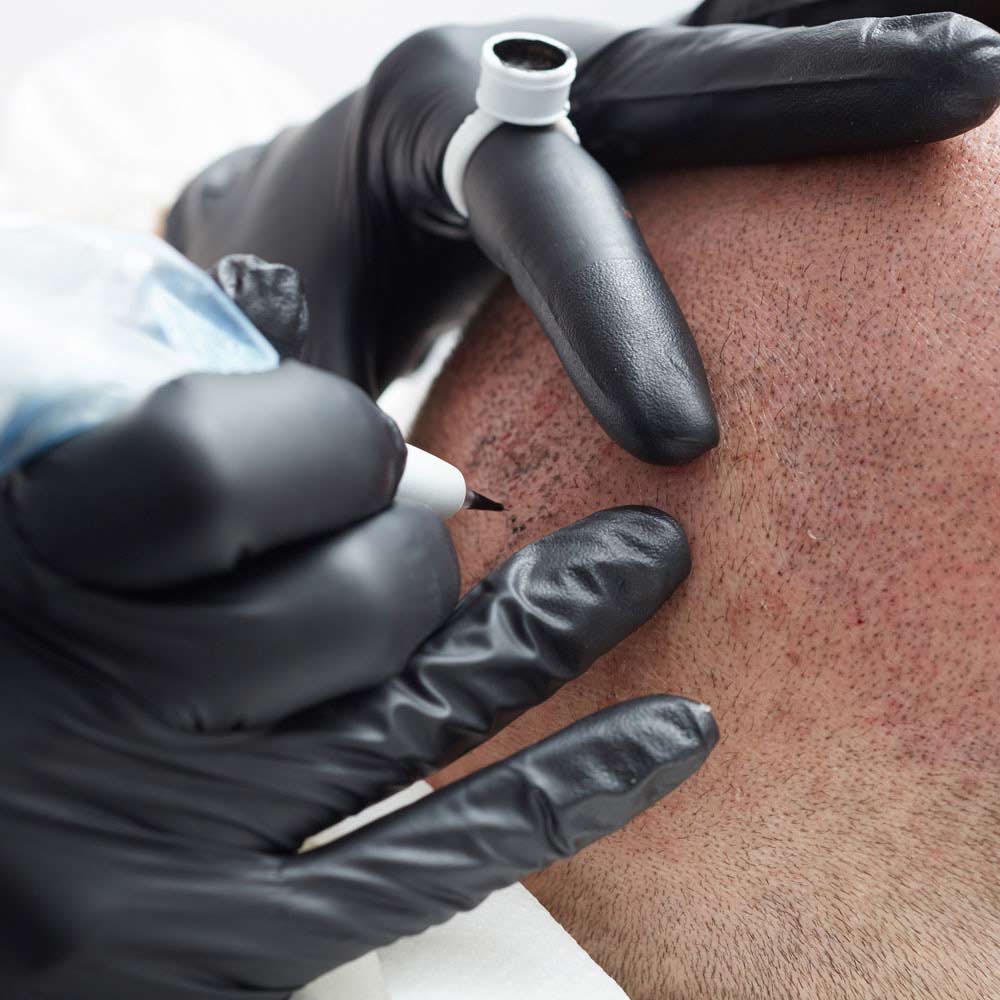 Close up of Scalp Micropigmentation in Los Angeles, California
