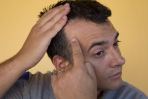 A man pointing to his receding hairline