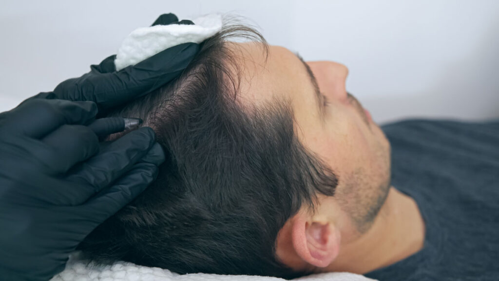Close-up photo of a man receiving a scalp micropigmentation treatment.