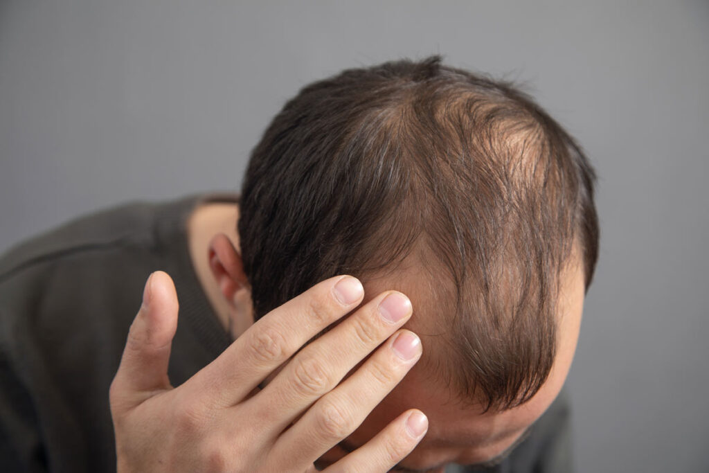 A man with thinning hair touching his head